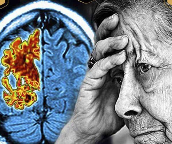 دلیل و علائم بیماری آلزایمر و روشهای درمان دارویی
